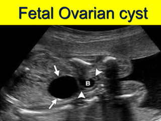 Fetal Ovarian cyst
 