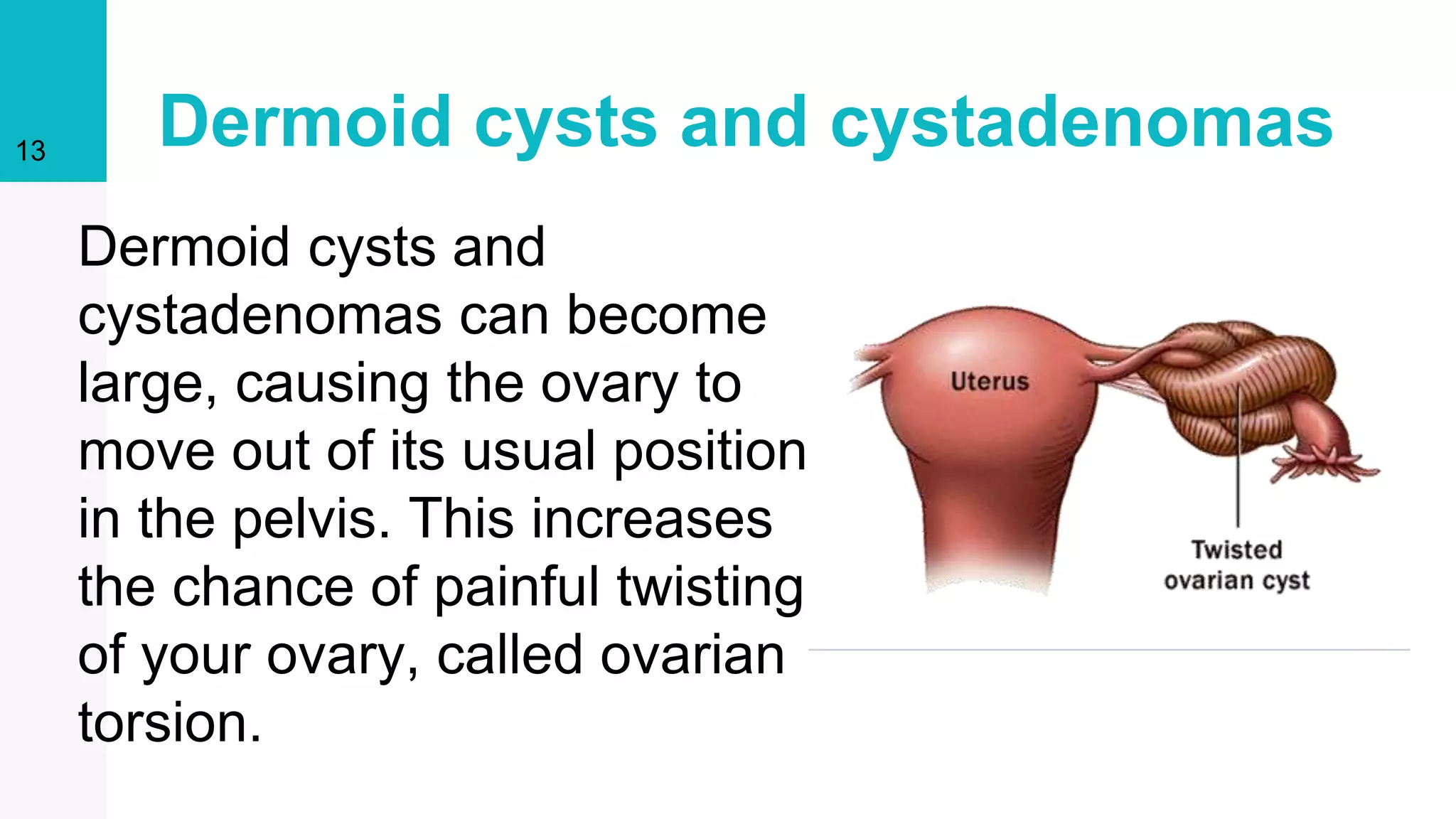 Moving Cyst Ovarian Cyst Causes | Ovarian Cyst Treatment |Ovarian Cyst Pain | PPTX