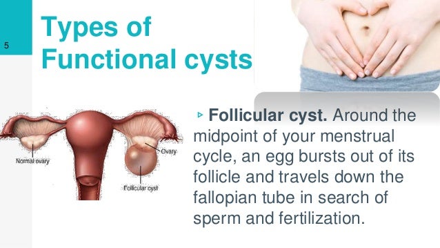 What are some causes of cysts?