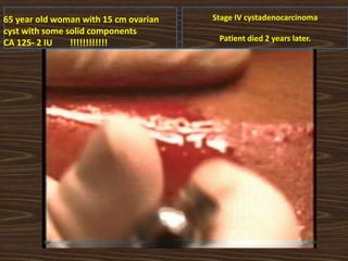 65 year old woman with 15 cm ovarian
cyst with some solid components
CA 125- 2 IU !!!!!!!!!!!!
Stage IV cystadenocarcinoma
Patient died 2 years later.
 