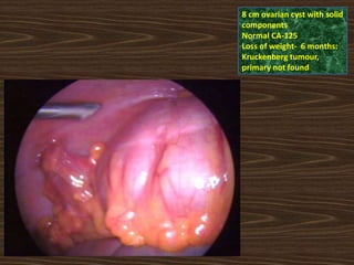 8 cm ovarian cyst with solid
components
Normal CA-125
Loss of weight- 6 months:
Kruckenberg tumour,
primary not found
 
