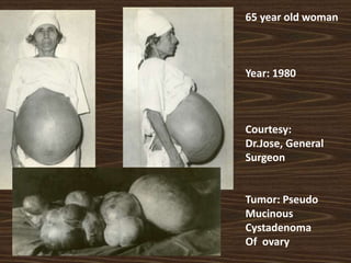 65 year old woman
Year: 1980
Courtesy:
Dr.Jose, General
Surgeon
Tumor: Pseudo
Mucinous
Cystadenoma
Of ovary
 