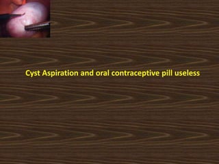 Cyst Aspiration and oral contraceptive pill useless
 