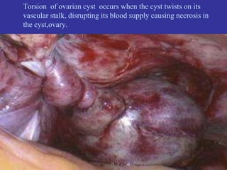 Torsion of ovarian cyst occurs when the cyst twists on its
vascular stalk, disrupting its blood supply causing necrosis in
the cyst,ovary.
 
