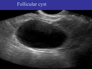 Follicular cyst
 