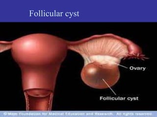 Follicular cyst
 