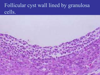 Follicular cyst wall lined by granulosa
cells.
 