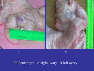 A B
Follicular cyst A-right ovary, B-left ovary.
 