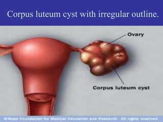 Corpus luteum cyst with irregular outline.
 