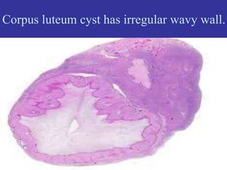 Corpus luteum cyst has irregular wavy wall.
 