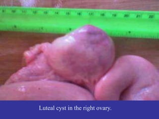 Luteal cyst in the right ovary.
 