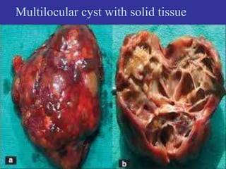 Multilocular cyst with solid tissue
 