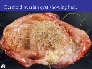 Dermoid ovarian cyst showing hair.
 