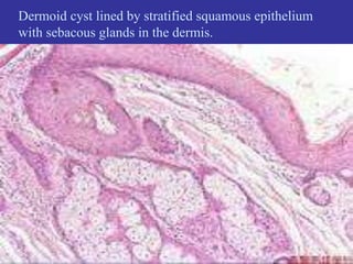 Dermoid cyst lined by stratified squamous epithelium
with sebacous glands in the dermis.
 