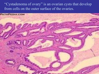 “Cystadenoma of ovary” is an ovarian cysts that develop
from cells on the outer surface of the ovaries.
 