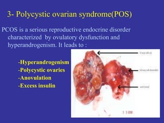 3- Polycystic ovarian syndrome(POS)
PCOS is a serious reproductive endocrine disorder
characterized by ovulatory dysfunction and
hyperandrogenism. It leads to :
-Hyperandrogenism
-Polycystic ovaries
-Anovulation
-Excess insulin
 