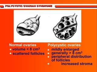 POLYCYSTIC OVARIAN SYNDROME
POLYCYSTIC OVARIAN SYNDROME
POLYCYSTIC OVARIAN SYNDROME


Normal ovaries
volume < 8 cm3
scattered follicles
mildly enlarged
generally > 8 cm3
peripheral distribution
of follicles
increased stroma
Polycystic ovaries






 