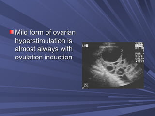 Mild form of ovarian hyperstimulation is almost always with ovulation induction 