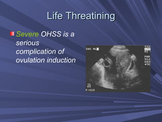 Life Threatining Severe  OHSS is a serious complication of ovulation induction 