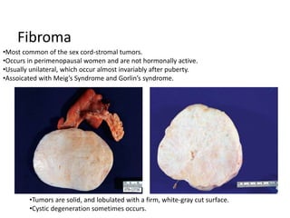 Fibroma
•Most common of the sex cord-stromal tumors.
•Occurs in perimenopausal women and are not hormonally active.
•Usually unilateral, which occur almost invariably after puberty.
•Assoicated with Meig’s Syndrome and Gorlin’s syndrome.
•Tumors are solid, and lobulated with a firm, white-gray cut surface.
•Cystic degeneration sometimes occurs.
 
