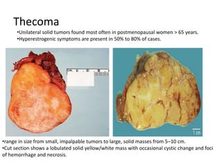 Thecoma
•Unilateral solid tumors found most often in postmenopausal women > 65 years.
•Hyperestrogenic symptoms are present in 50% to 80% of cases.
•range in size from small, impalpable tumors to large, solid masses from 5–10 cm.
•Cut section shows a lobulated solid yellow/white mass with occasional cystic change and foci
of hemorrhage and necrosis.
 
