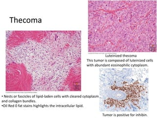 • Nests or fascicles of lipid-laden cells with cleared cytoplasm
and collagen bundles.
•Oil Red 0 fat stains highlights the intracellular lipid.
Thecoma
Luteinized thecoma
This tumor is composed of luteinized cells
with abundant eosinophilic cytoplasm.
Tumor is positive for inhibin.
 