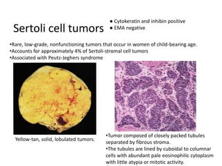 Sertoli cell tumors
•Rare, low-grade, nonfunctioning tumors that occur in women of child-bearing age.
•Accounts for approximately 4% of Sertoli-stromal cell tumors
•Associated with Peutz-Jeghers syndrome
•Tumor composed of closely packed tubules
separated by fibrous stroma.
•The tubules are lined by cuboidal to columnar
cells with abundant pale eosinophilic cytoplasm
with little atypia or mitotic activity.
Yellow-tan, solid, lobulated tumors.
● Cytokeratin and inhibin positive
● EMA negative
 