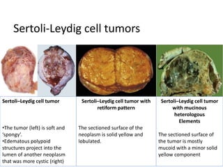 Sertoli-Leydig cell tumors
Sertoli–Leydig cell tumor
•The tumor (left) is soft and
‘spongy’.
•Edematous polypoid
structures project into the
lumen of another neoplasm
that was more cystic (right)
Sertoli–Leydig cell tumor with
retiform pattern
The sectioned surface of the
neoplasm is solid yellow and
lobulated.
Sertoli–Leydig cell tumor
with mucinous
heterologous
Elements
The sectioned surface of
the tumor is mostly
mucoid with a minor solid
yellow component
 