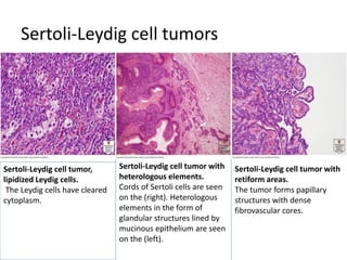 Sertoli-Leydig cell tumors
Sertoli-Leydig cell tumor,
lipidized Leydig cells.
The Leydig cells have cleared
cytoplasm.
Sertoli-Leydig cell tumor with
heterologous elements.
Cords of Sertoli cells are seen
on the (right). Heterologous
elements in the form of
glandular structures lined by
mucinous epithelium are seen
on the (left).
Sertoli-Leydig cell tumor with
retiform areas.
The tumor forms papillary
structures with dense
fibrovascular cores.
 