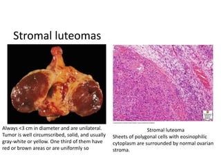 Stromal luteomas
Always <3 cm in diameter and are unilateral.
Tumor is well circumscribed, solid, and usually
gray-white or yellow. One third of them have
red or brown areas or are uniformly so
Stromal luteoma
Sheets of polygonal cells with eosinophilic
cytoplasm are surrounded by normal ovarian
stroma.
 