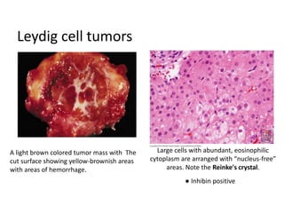 Leydig cell tumors
Large cells with abundant, eosinophilic
cytoplasm are arranged with “nucleus-free”
areas. Note the Reinke's crystal.
A light brown colored tumor mass with The
cut surface showing yellow-brownish areas
with areas of hemorrhage.
● Inhibin positive
 