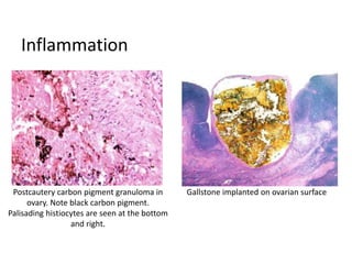 Inflammation
Gallstone implanted on ovarian surfacePostcautery carbon pigment granuloma in
ovary. Note black carbon pigment.
Palisading histiocytes are seen at the bottom
and right.
 