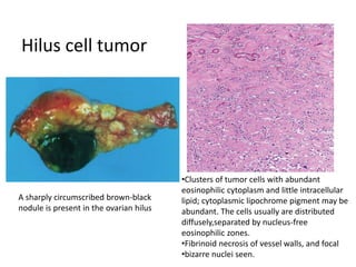 Hilus cell tumor
A sharply circumscribed brown-black
nodule is present in the ovarian hilus
•Clusters of tumor cells with abundant
eosinophilic cytoplasm and little intracellular
lipid; cytoplasmic lipochrome pigment may be
abundant. The cells usually are distributed
diffusely,separated by nucleus-free
eosinophilic zones.
•Fibrinoid necrosis of vessel walls, and focal
•bizarre nuclei seen.
 