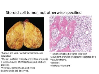 Steroid cell tumor, not otherwise specified
•Tumors are solid, well circumscribed, and
lobulated.
•The cut surfaces typically are yellow or orange
if large amounts of intracytoplasmic lipid are
present.
•Necrosis, hemorrhage, and cystic
degeneration are observed.
•Tumor composed of large cells with
•abundant granular cytoplasm separated by a
vascular stroma.
•Reinke's
•crystals are absent
 