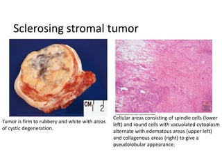 Sclerosing stromal tumor
Tumor is firm to rubbery and white with areas
of cystic degeneration.
Cellular areas consisting of spindle cells (lower
left) and round cells with vacuolated cytoplasm
alternate with edematous areas (upper left)
and collagenous areas (right) to give a
pseudolobular appearance.
 