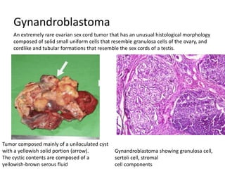 Gynandroblastoma
Gynandroblastoma showing granulosa cell,
sertoli cell, stromal
cell components
Tumor composed mainly of a uniloculated cyst
with a yellowish solid portion (arrow).
The cystic contents are composed of a
yellowish-brown serous fluid
An extremely rare ovarian sex cord tumor that has an unusual histological morphology
composed of solid small uniform cells that resemble granulosa cells of the ovary, and
cordlike and tubular formations that resemble the sex cords of a testis.
 