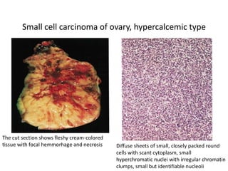 Small cell carcinoma of ovary, hypercalcemic type
Diffuse sheets of small, closely packed round
cells with scant cytoplasm, small
hyperchromatic nuclei with irregular chromatin
clumps, small but identifiable nucleoli
The cut section shows fleshy cream-colored
tissue with focal hemmorhage and necrosis
 