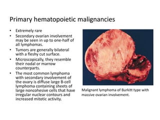 Primary hematopoietic malignancies
• Extremely rare
• Secondary ovarian involvement
may be seen in up to one-half of
all lymphomas.
• Tumors are generally bilateral
with a fleshy cut surface.
• Microscopically, they resemble
their nodal or marrow
counterparts.
• The most common lymphoma
with secondary involvement of
the ovary is diffuse large B-cell
lymphoma containing sheets of
large noncohesive cells that have
irregular nuclear contours and
increased mitotic activity.
Malignant lymphoma of Burkitt type with
massive ovarian involvement.
 