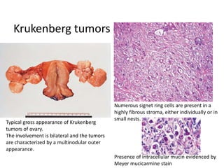Krukenberg tumors of ovary
Typical gross appearance of Krukenberg
tumors of ovary.
The involvement is bilateral and the tumors
are characterized by a multinodular outer
appearance.
Numerous signet ring cells are present in a
highly fibrous stroma, either individually or in
small nests.
Presence of intracellular mucin evidenced by
Meyer mucicarmine stain
 