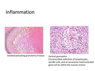 Inflammation
Isolated palisading granuloma of ovary Cortical granuloma.
Circumscribed collection of lymphocytes,
spindle cells, and an occasional multinucleated
giant cell lie within the ovarian stroma
 