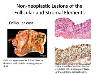 Non-neoplastic Lesions of the
Follicular and Stromal Elements
Lining consists of an inner layer of
granulosa cells and an outer layer
of theca interna cells(reticulin).
Follicular cyst
Follicular cysts measure 2.5 to 10 cm in
diameter and contain serosanguineous
fluid.
 