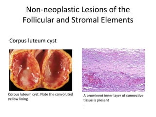 Non-neoplastic Lesions of the
Follicular and Stromal Elements
A prominent inner layer of connective
tissue is present
.
Corpus luteum cyst
Corpus luteum cyst. Note the convoluted
yellow lining
 