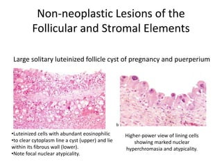 Non-neoplastic Lesions of the
Follicular and Stromal Elements
Higher-power view of lining cells
showing marked nuclear
hyperchromasia and atypicality.
•Luteinized cells with abundant eosinophilic
•to clear cytoplasm line a cyst (upper) and lie
within its fibrous wall (lower).
•Note focal nuclear atypicality.
Large solitary luteinized follicle cyst of pregnancy and puerperium
 