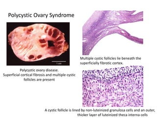 Polycystic ovary disease.
Superficial cortical fibrosis and multiple cystic
follicles are present
Multiple cystic follicles lie beneath the
superficially fibrotic cortex.
A cystic follicle is lined by non-luteinized granulosa cells and an outer,
thicker layer of luteinized theca interna cells
Polycystic Ovary Syndrome
 