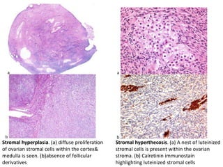 Stromal hyperplasia. (a) diffuse proliferation
of ovarian stromal cells within the cortex&
medulla is seen. (b)absence of follicular
derivatives
Stromal hyperthecosis. (a) A nest of luteinized
stromal cells is present within the ovarian
stroma. (b) Calretinin immunostain
highlighting luteinized stromal cells
 
