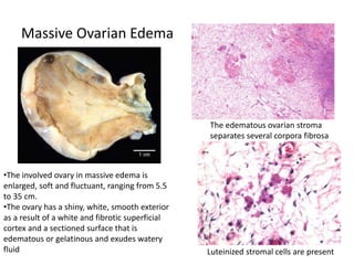 Massive Ovarian Edema
•The involved ovary in massive edema is
enlarged, soft and fluctuant, ranging from 5.5
to 35 cm.
•The ovary has a shiny, white, smooth exterior
as a result of a white and fibrotic superficial
cortex and a sectioned surface that is
edematous or gelatinous and exudes watery
fluid
The edematous ovarian stroma
separates several corpora fibrosa
Luteinized stromal cells are present
 