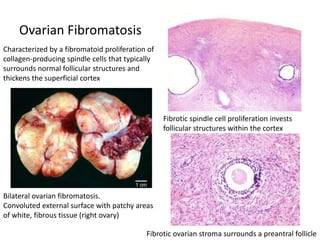 Ovarian Fibromatosis
Bilateral ovarian fibromatosis.
Convoluted external surface with patchy areas
of white, fibrous tissue (right ovary)
Fibrotic spindle cell proliferation invests
follicular structures within the cortex
Fibrotic ovarian stroma surrounds a preantral follicle
Characterized by a fibromatoid proliferation of
collagen-producing spindle cells that typically
surrounds normal follicular structures and
thickens the superficial cortex
 