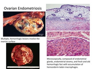 Ovarian Endometriosis
Multiple, hemorrhagic lesions involve the
ovarian surface
Microscopically, composed of endometrial
glands, endometrial stroma, and fresh and old
hemorrhagic foci with accumulation of
hemosiderin-laden macrophages.
 