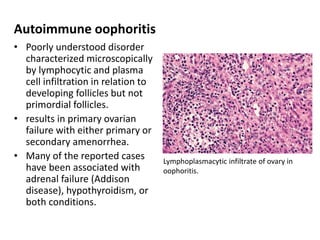 Autoimmune oophoritis
• Poorly understood disorder
characterized microscopically
by lymphocytic and plasma
cell infiltration in relation to
developing follicles but not
primordial follicles.
• results in primary ovarian
failure with either primary or
secondary amenorrhea.
• Many of the reported cases
have been associated with
adrenal failure (Addison
disease), hypothyroidism, or
both conditions.
Lymphoplasmacytic infiltrate of ovary in
oophoritis.
 