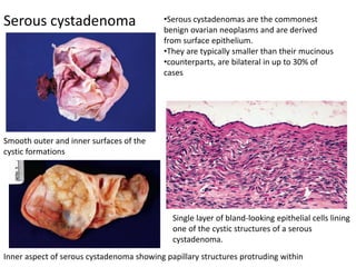 Smooth outer and inner surfaces of the
cystic formations
Inner aspect of serous cystadenoma showing papillary structures protruding within
Serous cystadenoma
Single layer of bland-looking epithelial cells lining
one of the cystic structures of a serous
cystadenoma.
•Serous cystadenomas are the commonest
benign ovarian neoplasms and are derived
from surface epithelium.
•They are typically smaller than their mucinous
•counterparts, are bilateral in up to 30% of
cases
 
